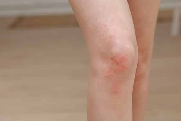 Removing Body Hair Chemically