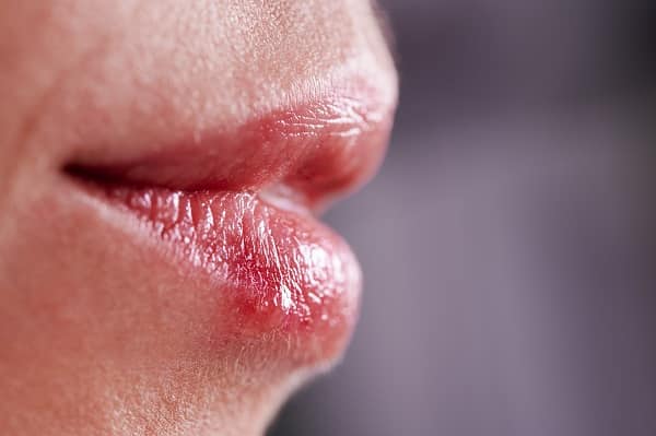 lip fillers
