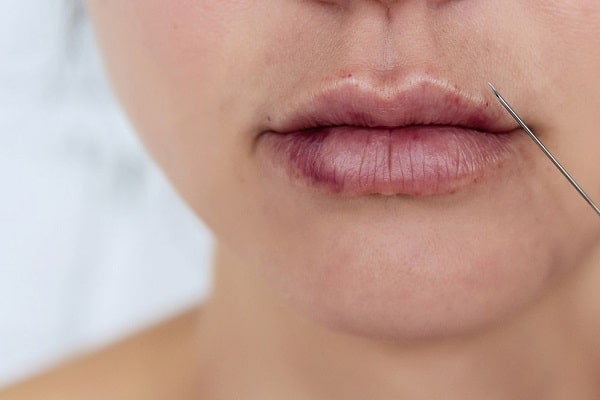 lip fillers