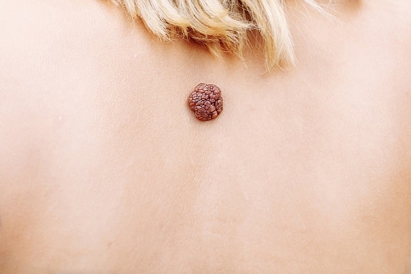 Moles